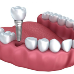 Diş İmplantı Nedir? Avantajları ve Dezavantajları